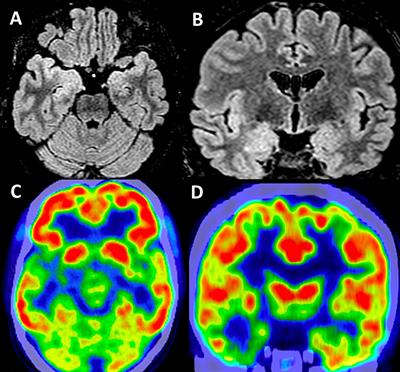 Musicogenic seizures in temporal lobe epilepsy: Case reports based on ictal source localization analysis